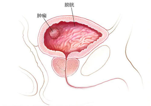 ：膀胱癌的早期症状是什么？ 