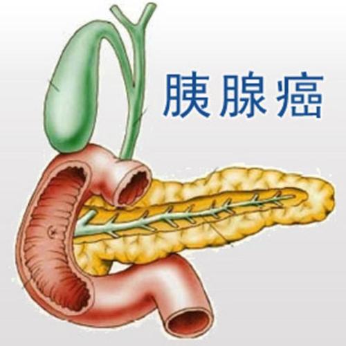 杭州御和堂中医提醒：糖尿病患者每年应查胰腺癌 高危人群要提高警惕！
