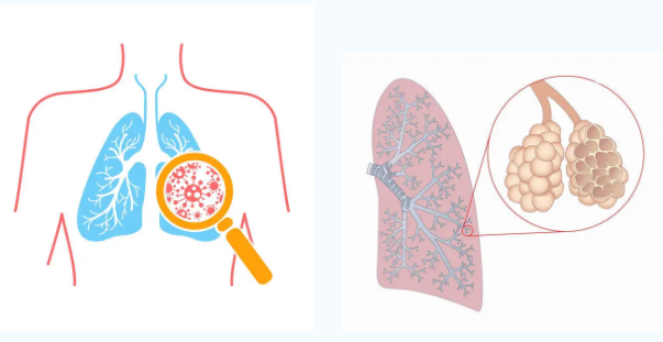 中医可以治疗肺大泡吗？如何治疗？