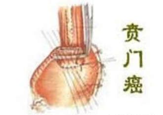 贲门癌转移