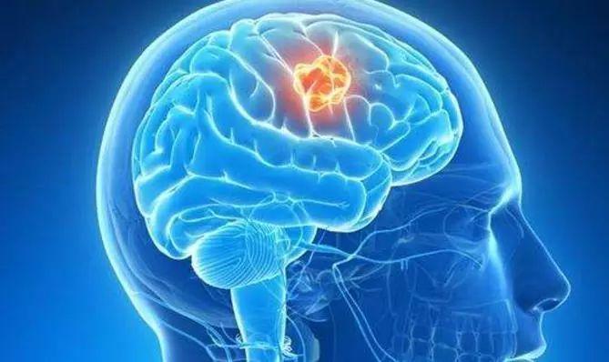脑癌的致病因素有哪些?