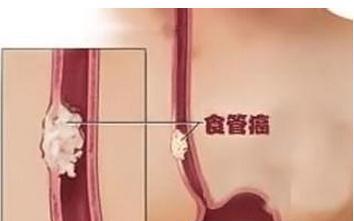 五大“信号”,或提示早期食管癌!重视起来!