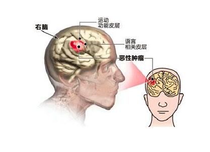 中医脑癌的诊断要点有哪些?