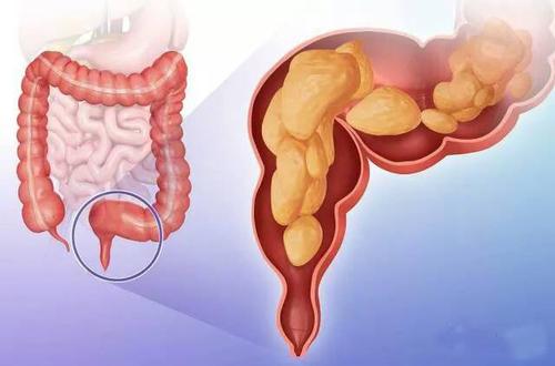直肠癌的临床症状有哪些？这些你了解过吗？