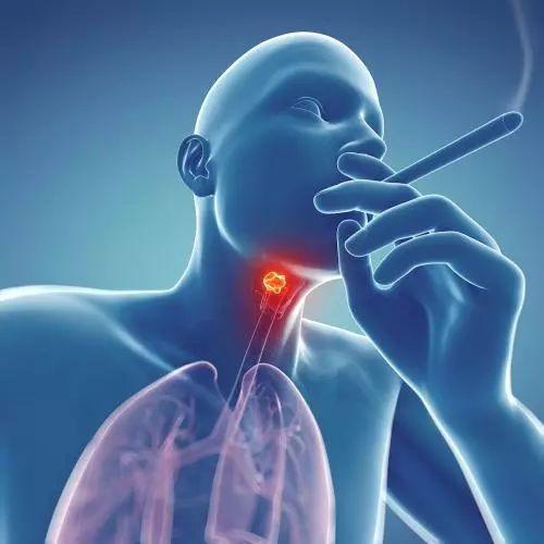 喉癌晚期患者会有哪些症状？这些症状你知道吗？