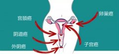 女性原发性外阴癌会发生哪些并发症？