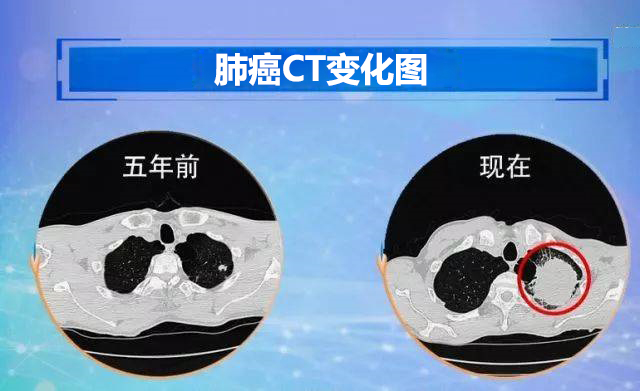 1646104374166088.jpg 杭州御承堂中医:患上肺癌晚期能活多长时间?